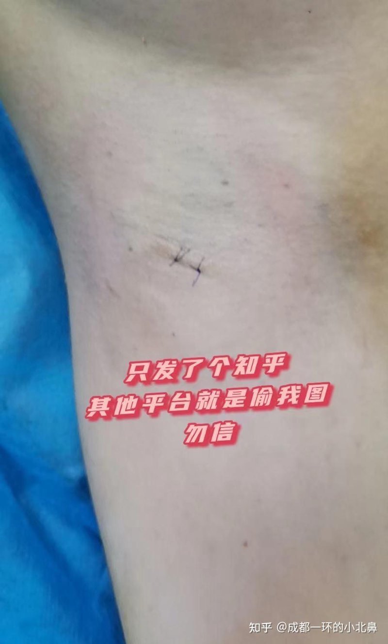 治疗狐臭哪家医院好？选择适合自己的治疗方案